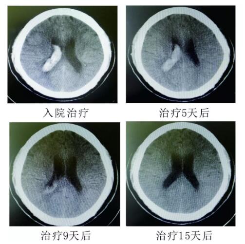 腦出血你不得不引起重視的疾?。。?！