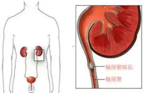 輸尿管結(jié)石，到底能不能保守治療？