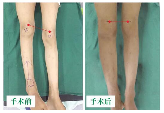 女孩墜梯右腿縮短5cm，幸得醫(yī)生及時診治恢復(fù)正常腿型