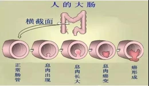 體檢發(fā)現(xiàn)腸息肉會(huì)癌變嗎？